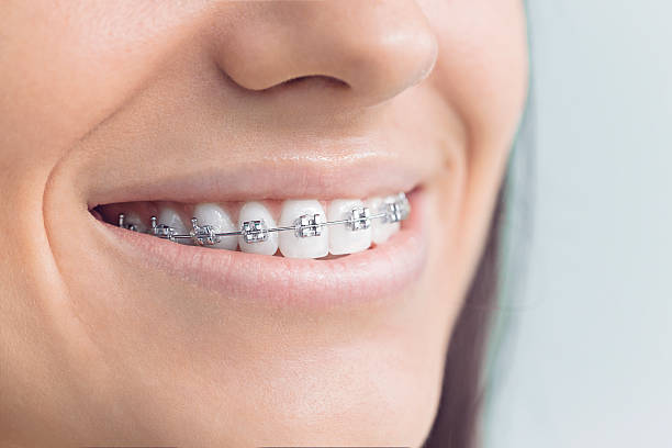 Best Veneers and Lumineers  in Speedway, IN